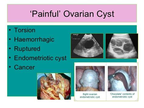 best test for ovarian torsion|twisted or ruptured ovarian cyst.